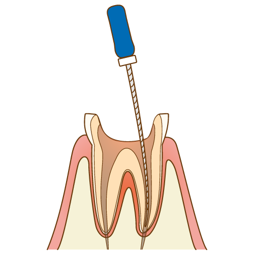 大森駅・大森わたなべ歯科・根管治療