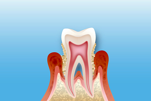 大森駅・大森わたなべ歯科歯周病とは