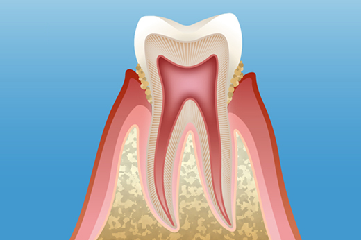 大森駅・大森わたなべ歯科軽度歯周炎