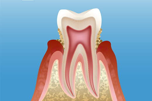 大森駅・大森わたなべ歯科中等度歯周炎